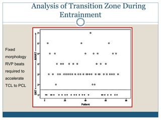 Fixed
morphology
RVP beats
required to
accelerate
TCL to PCL
Analysis of Transition Zone During
Entrainment
 