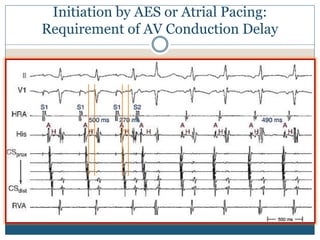 Initiation by AES or Atrial Pacing:
Requirement of AV Conduction Delay
 