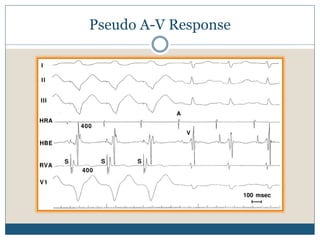 Pseudo A-V Response
 