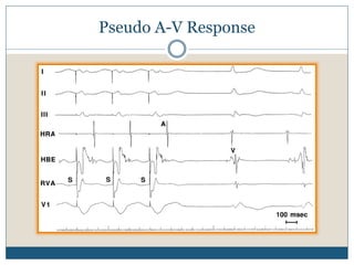 Pseudo A-V Response
 