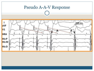 Pseudo A-A-V Response
 
