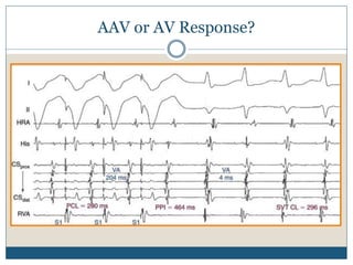 AAV or AV Response?
 