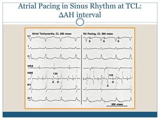 Atrial Pacing in Sinus Rhythm at TCL:
ΔAH interval
 