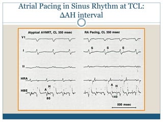 Atrial Pacing in Sinus Rhythm at TCL:
ΔAH interval
 