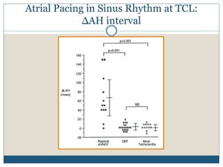 Atrial Pacing in Sinus Rhythm at TCL:
ΔAH interval
 