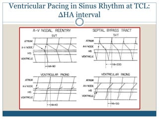 Ventricular Pacing in Sinus Rhythm at TCL:
ΔHA interval
 
