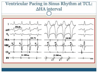 Ventricular Pacing in Sinus Rhythm at TCL:
ΔHA interval
 