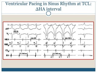 Ventricular Pacing in Sinus Rhythm at TCL:
ΔHA interval
 