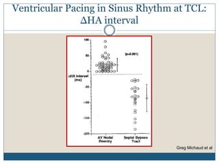 Ventricular Pacing in Sinus Rhythm at TCL:
ΔHA interval
Greg Michaud et al
 