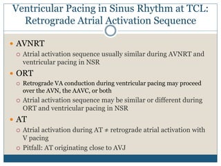 Ventricular Pacing in Sinus Rhythm at TCL:
Retrograde Atrial Activation Sequence
 AVNRT
 Atrial activation sequence usually similar during AVNRT and
ventricular pacing in NSR
 ORT
 Retrograde VA conduction during ventricular pacing may proceed
over the AVN, the AAVC, or both
 Atrial activation sequence may be similar or different during
ORT and ventricular pacing in NSR
 AT
 Atrial activation during AT ≠ retrograde atrial activation with
V pacing
 Pitfall: AT originating close to AVJ
 