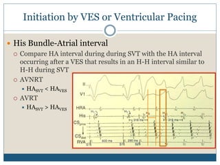 Initiation by VES or Ventricular Pacing
 His Bundle-Atrial interval
 Compare HA interval during during SVT with the HA interval
occurring after a VES that results in an H-H interval similar to
H-H during SVT
 AVNRT
 HASVT < HAVES
 AVRT
 HASVT > HAVES
 