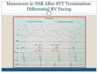 Maneuvers in NSR After SVT Termination:
Differential RV Pacing
 