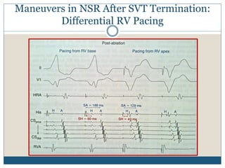 Maneuvers in NSR After SVT Termination:
Differential RV Pacing
2
 