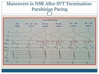 Maneuvers in NSR After SVT Termination:
Parahisian Pacing
 