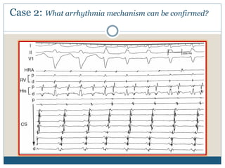 Case 2: What arrhythmia mechanism can be confirmed?
 