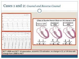 Cases 1 and 2: Coumel and Reverse Coumel
BCT LBBB and NCT, VA association, eccentric CS activation, no change in CL or VA time with
change from LBBB to NCT
 