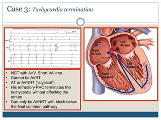 Case 3: Tachycardia termination
• NCT with A>V. Short VA time
• Cannot be AVRT
• AT or AVNRT (“atypical”)
• His refractory PVC terminates the
tachycardia without affecting the
atrium
• Can only be AVNRT with block below
the final common pathway
 