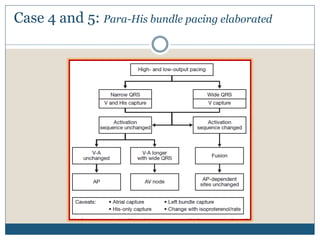 Case 4 and 5: Para-His bundle pacing elaborated
 