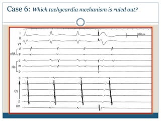 Case 6: Which tachycardia mechanism is ruled out?
 