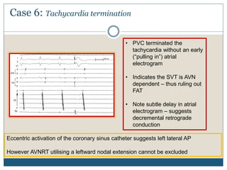 Case 6: Tachycardia termination
Eccentric activation of the coronary sinus catheter suggests left lateral AP
However AVNRT utilising a leftward nodal extension cannot be excluded
• PVC terminated the
tachycardia without an early
(“pulling in”) atrial
electrogram
• Indicates the SVT is AVN
dependent – thus ruling out
FAT
• Note subtle delay in atrial
electrogram – suggests
decremental retrograde
conduction
 