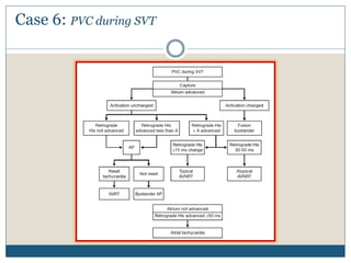 Case 6: PVC during SVT
 