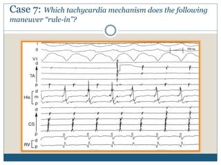 Case 7: Which tachycardia mechanism does the following
maneuver “rule-in”?
 