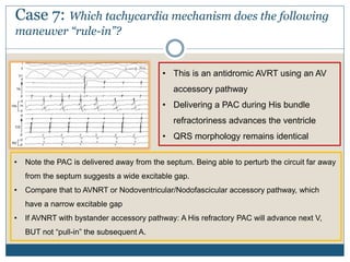 Case 7: Which tachycardia mechanism does the following
maneuver “rule-in”?
• Note the PAC is delivered away from the septum. Being able to perturb the circuit far away
from the septum suggests a wide excitable gap.
• Compare that to AVNRT or Nodoventricular/Nodofascicular accessory pathway, which
have a narrow excitable gap
• If AVNRT with bystander accessory pathway: A His refractory PAC will advance next V,
BUT not “pull-in” the subsequent A.
• This is an antidromic AVRT using an AV
accessory pathway
• Delivering a PAC during His bundle
refractoriness advances the ventricle
• QRS morphology remains identical
 