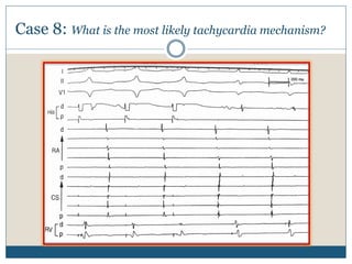 Case 8: What is the most likely tachycardia mechanism?
 