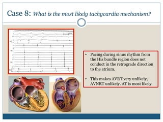 Case 8: What is the most likely tachycardia mechanism?
• Pacing during sinus rhythm from
the His bundle region does not
conduct in the retrograde direction
to the atrium.
• This makes AVRT very unlikely,
AVNRT unlikely. AT is most likely
 