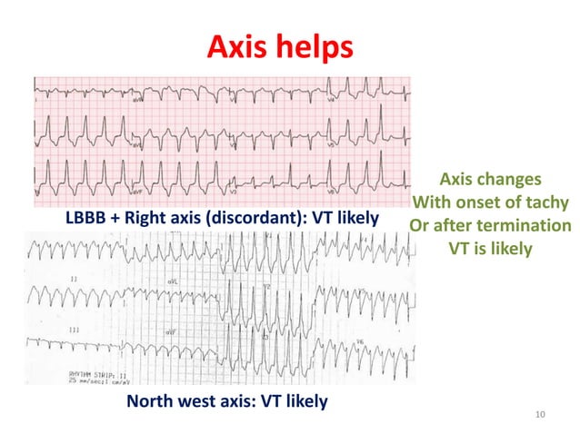 Supraventricular tachycardia: ECG recognition and diagnosis | PPTX