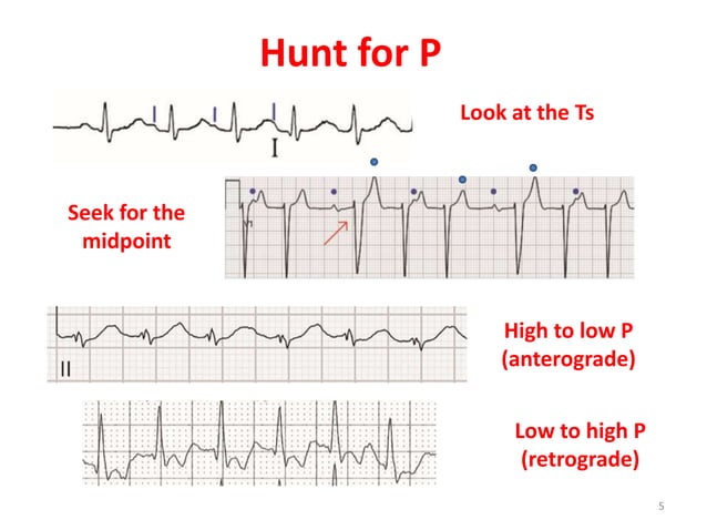 Supraventricular tachycardia: ECG recognition and diagnosis | PPTX