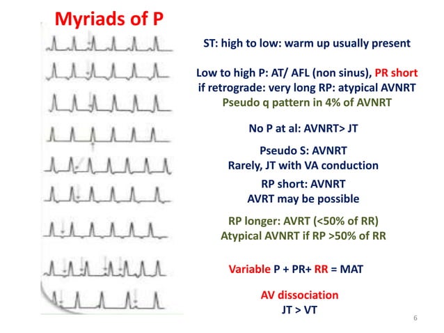 Svt Algorithm Rp Interval Supraventricular tachycardia: ECG recognition and diagnosis | PPTX
