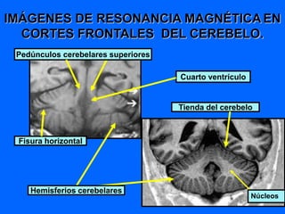 IMÁGENES DE RESONANCIA MAGNÉTICA EN
CORTES FRONTALES DEL CEREBELO.
Cuarto ventrículo
Pedúnculos cerebelares superiores
Fisura horizontal
Hemisferios cerebelares
Tienda del cerebelo
Núcleos
 