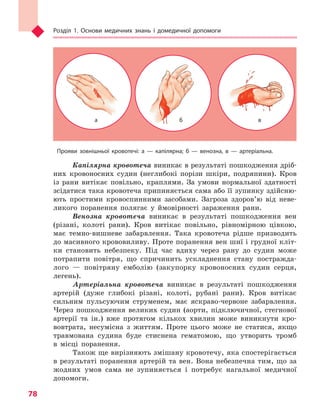 Розділ 1. Основи медичних знань і домедичної допомоги
78
Прояви зовнішньої кровотечі: а  — капілярна;  б  — венозна, в — артеріальна.
Капілярна кровотеча виникає в результаті пошкодження дріб-
них кровоносних судин (неглибокі порізи шкіри, подряпини). Кров
із рани витікає повільно, краплями. За умови нормальної здатності
зсідатися така кровотеча припиняється сама або її зупинку здійсню-
ють простими кровоспинними засобами. Загроза здоров’ю від неве-
ликого поранення полягає у ймовірності зараження рани.
Венозна кровотеча виникає в результаті пошкодження вен
(різані, колоті рани). Кров витікає повільно, рівномірною цівкою,
має темно-вишневе забарвлення. Така кровотеча рідше призводить
до масивного крововиливу. Проте поранення вен шиї і грудної кліт-
ки становить небезпеку. Під час вдиху через рану до судин може
потрапити повітря, що спричинить ускладнення стану постражда-
лого — повітряну емболію (закупорку кровоносних судин серця,
легень).
Артеріальна кровотеча виникає в результаті пошкодження
артерій (дуже глибокі різані, колоті, рубані рани). Кров витікає
сильним пульсуючим струменем, має яскраво-червоне забарвлення.
Через пошкодження великих судин (аорти, підключичної, стегнової
артерії та ін.) вже протягом кількох хвилин може виникнути кро-
вовтрата, несумісна з життям. Проте цього може не статися, якщо
травмована судина буде стиснена гематомою, що утворить тромб
в місці поранення.
Також ще вирізняють змішану кровотечу, яка спостерігається
в результаті поранення артерій та вен. Вона небезпечна тим, що за
жодних умов сама не зупиняється і потребує нагальної медичної
допомоги.
а б в
Право для безоплатного розміщення підручника в мережі Інтернет має
Міністерство освіти і науки України http://mon.gov.ua/ та Інститут модернізації змісту освіти https://imzo.gov.ua
 