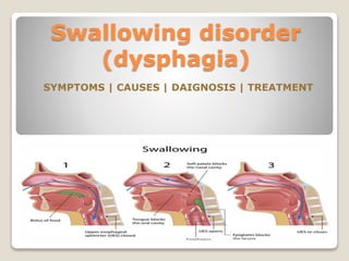 Swallowing disorder
(dysphagia)
SYMPTOMS | CAUSES | DAIGNOSIS | TREATMENT
 