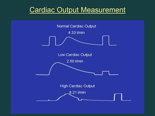 Pulmonary artery Catheter | PPT