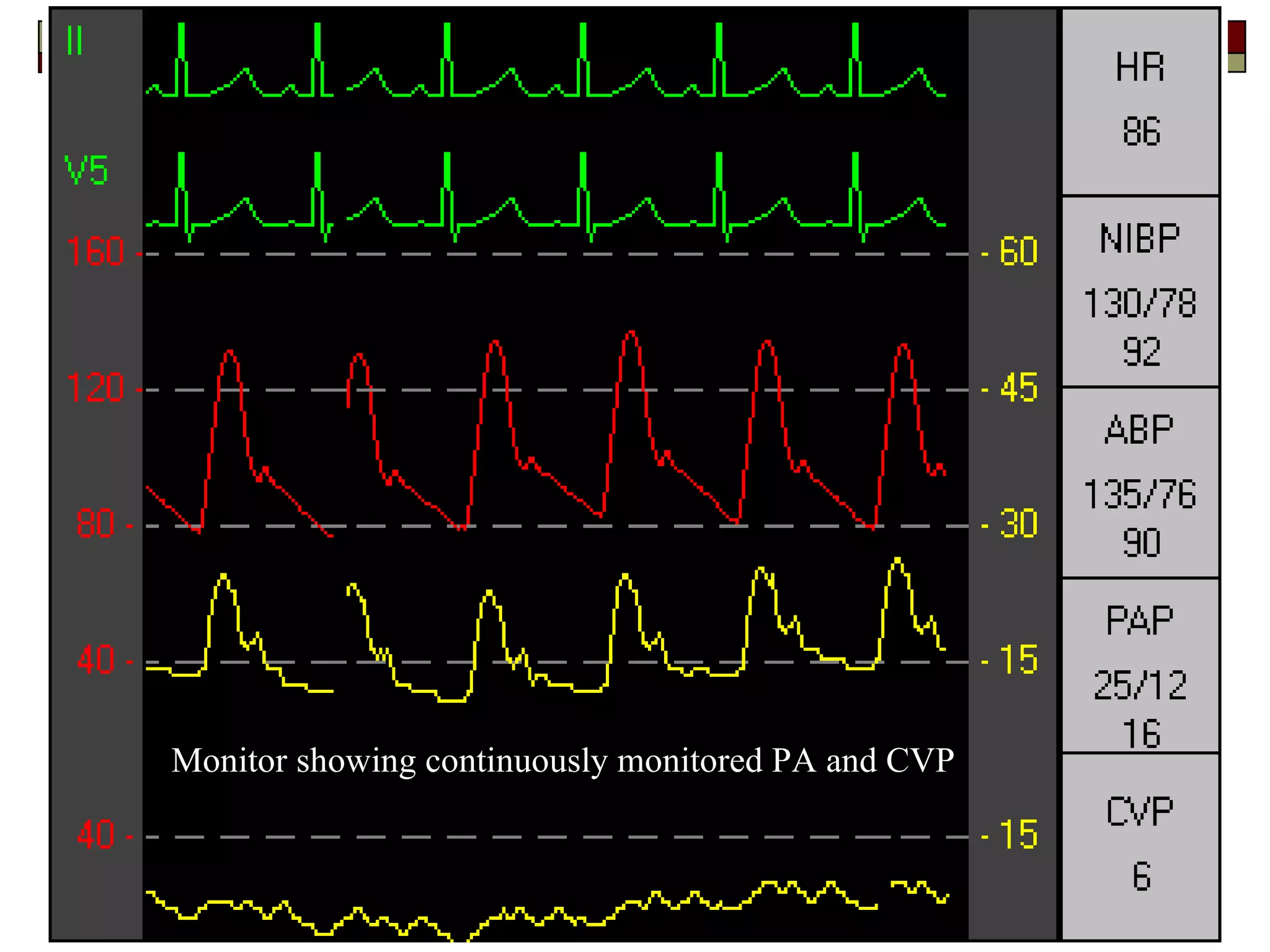 Monitor showing continuously monitored PA and CVP
 