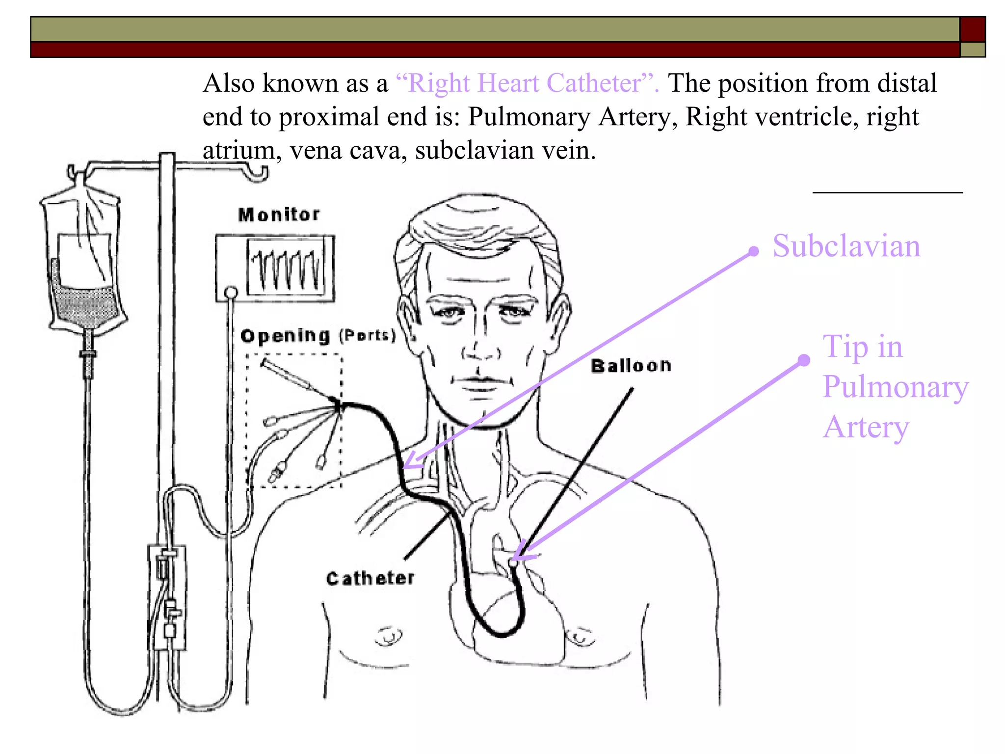Also known as a “Right Heart Catheter”. The position from distal
end to proximal end is: Pulmonary Artery, Right ventricle, right
atrium, vena cava, subclavian vein.


                                                 Subclavian


                                                     Tip in
                                                     Pulmonary
                                                     Artery
 