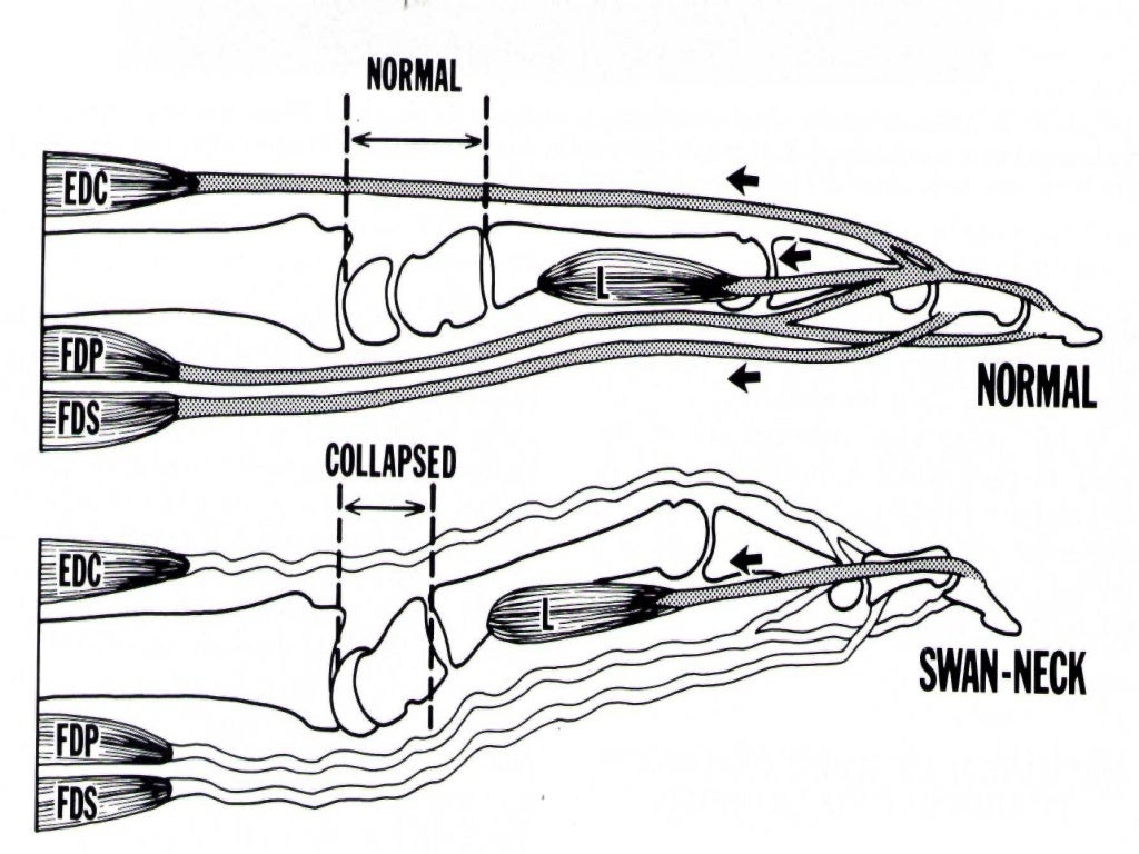 Swan neck deformityw