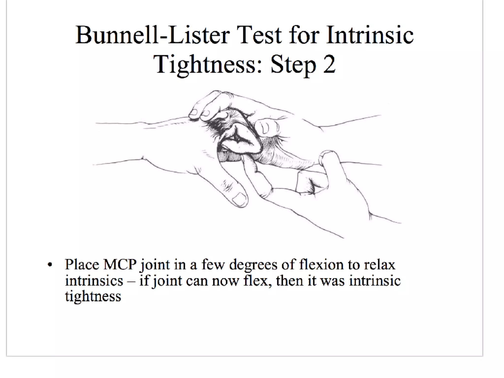 Swan neck deformity and hand surgery
