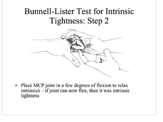 Swan neck deformity and hand surgery