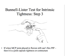 Swan neck deformity and hand surgery