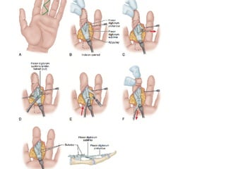 Swan neck deformity and hand surgery