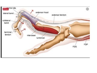 Swan neck deformity and hand surgery