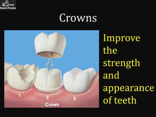 Crowns
         Improve
         the
         strength
         and
         appearance
         of teeth
 