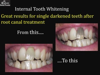 Internal Tooth Whitening
Great results for single darkened teeth after
root canal treatment

       From this.....




                           ....To this
 