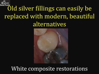 Old silver fillings can easily be
replaced with modern, beautiful
           alternatives




  White composite restorations
 