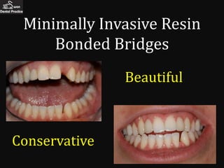 Minimally Invasive Resin
     Bonded Bridges
               Beautiful



Conservative
 