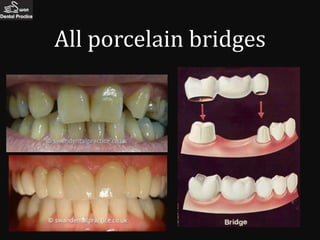 All porcelain bridges
              Beautiful

              Exceptionally
              strong

              Long lasting
 