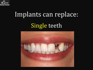 Implants can replace:
     Single teeth
 